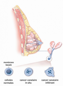 Types de cancer du sein 